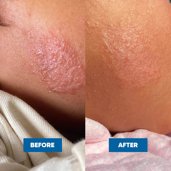Before and after comparison of skin texture on a person's arm.